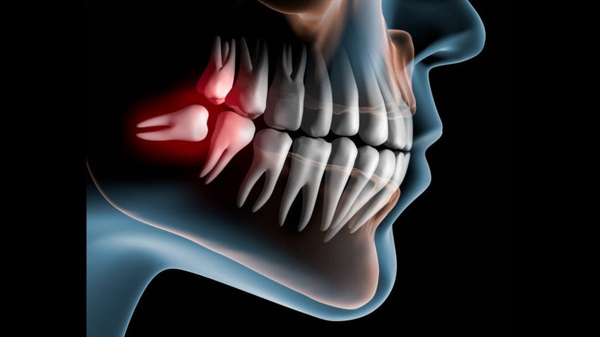 Dental illustration highlighting an impacted wisdom tooth in the jaw