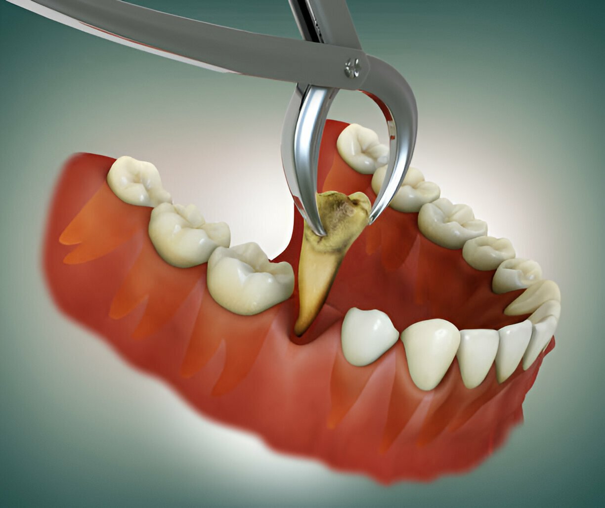 Tooth Extraction