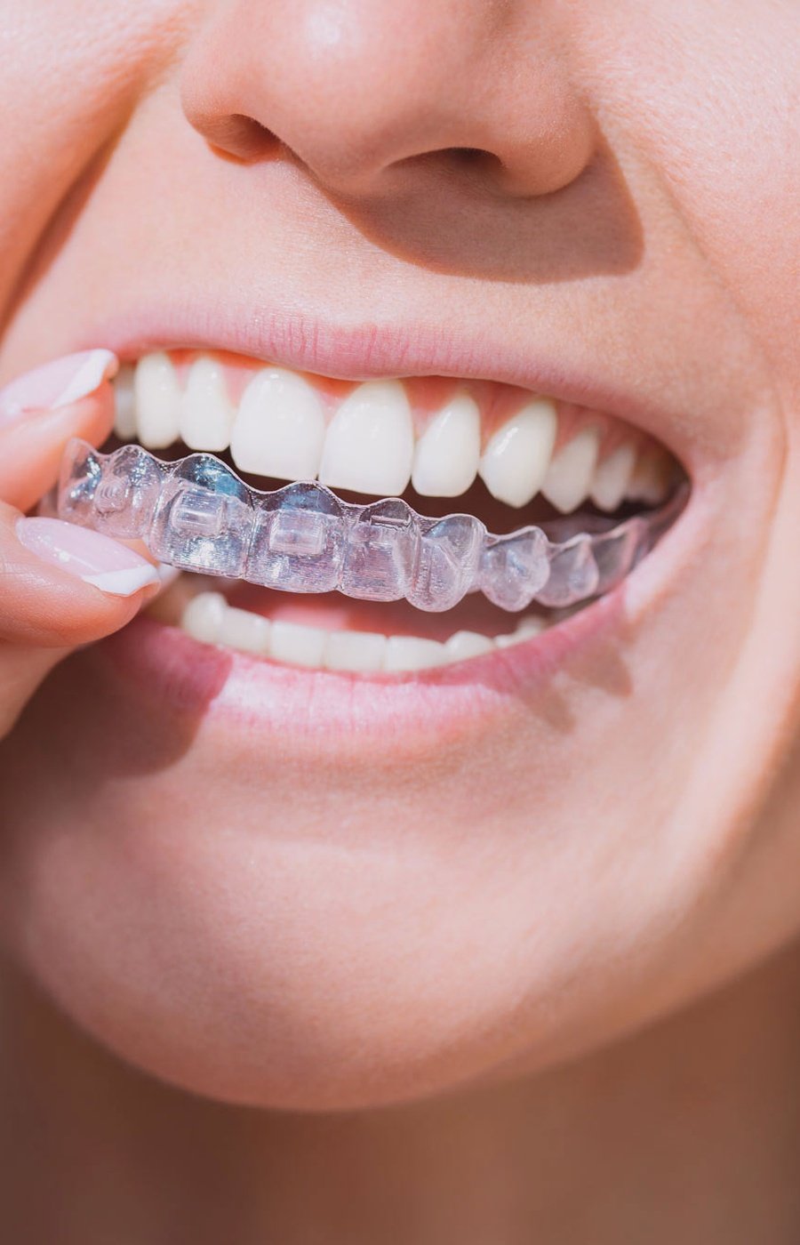 Invisalign clear aligners