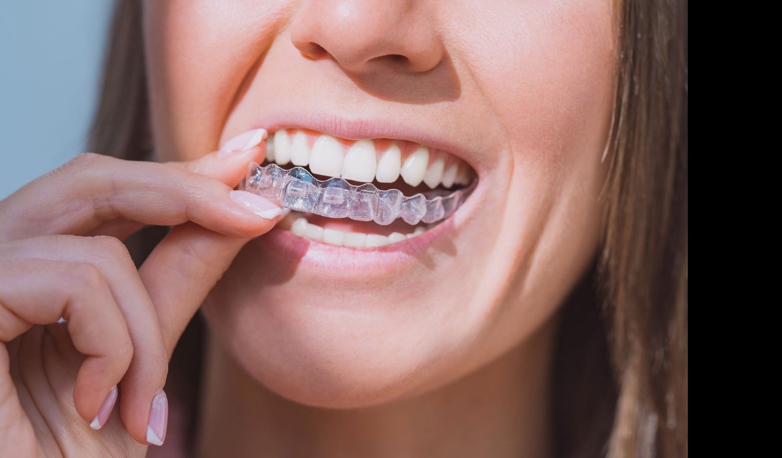 Invisalign® clear aligners