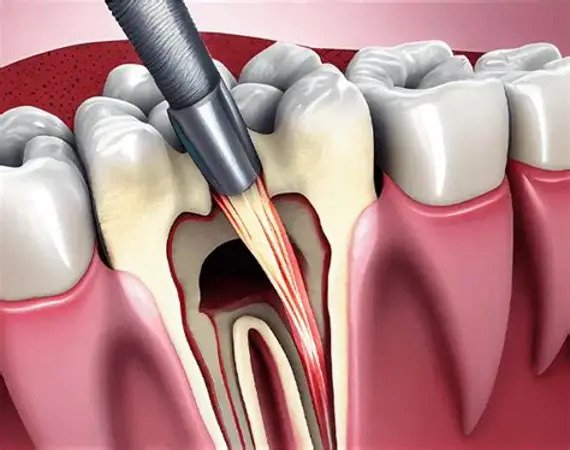 Root Canals & Endodontics