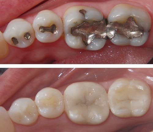 Fillings
