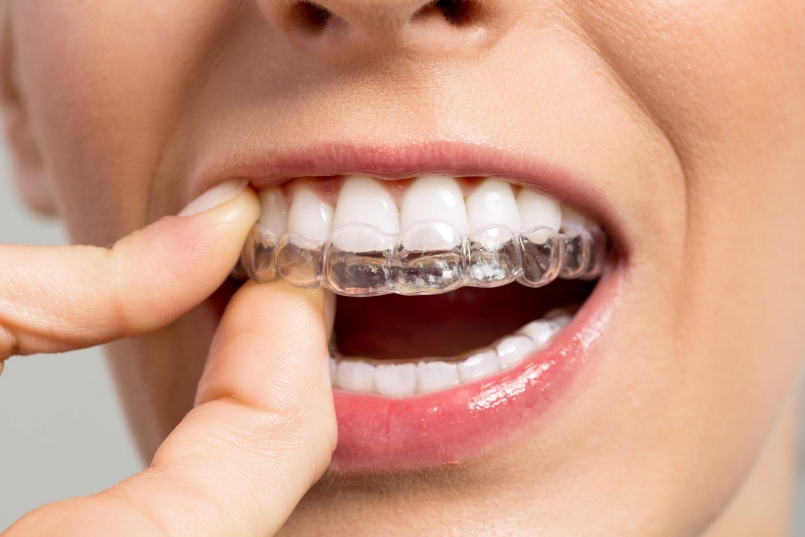 Invisalign® supporting image at Monalisa Dental Centre