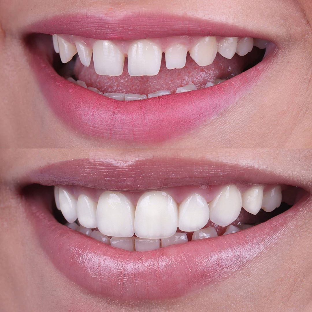 Veneers